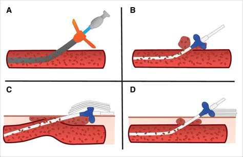 bills a screw pump heart|Percutaneous Transvalvular Microaxial .